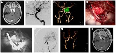 Clinical effect of high-flow revascularization in microsurgery combined with endoscopic endonasal surgery for skull base tumors with intracranial and extracranial involvement